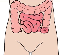 Colostomy